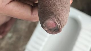 Penis peyronies and phimosis: an overview